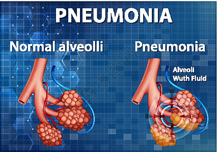 健康肺泡与肺炎的比较插图器官x光空气疾病海报气体学习微生物学生物学图片
