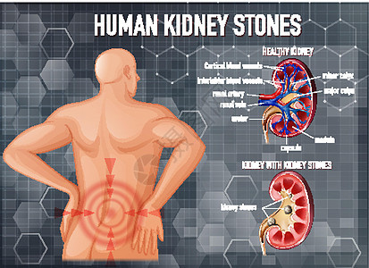 健康肾与结石肾对比信息肾脏石头病理卡通片身体微生物学意义教育男人图片