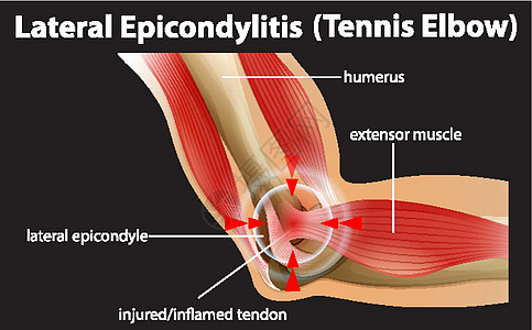 外侧上髁炎或网球肘运动病人疾病框架整脊神经学习生物教育科学图片
