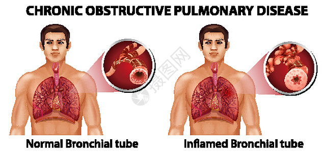 慢性阻塞性肺病教育管子疾病插图学习x光生物学信息器官解剖学图片