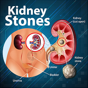 肾结石资料图信息肾脏身体药品解剖学绘画剪贴微生物学意义卡通片图片