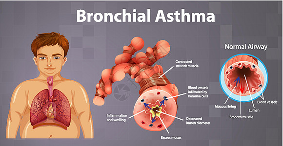 哮喘发炎的支气管管图表教育卡通片学习管子呼吸道x光男人病理插图图片