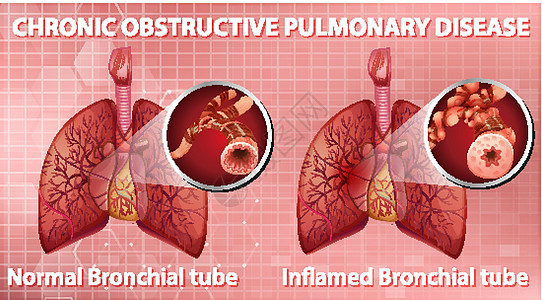慢性阻塞性肺病管子支气管器官疾病图表微生物学x光科学信息解剖学图片