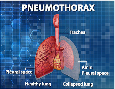 气胸的资料图气管药品学习解剖学病理疾病插图x光图表信息图片
