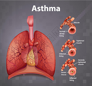 人体解剖学哮喘图疾病哮喘教育信息病理解剖学科学管子学习卡通片背景图片
