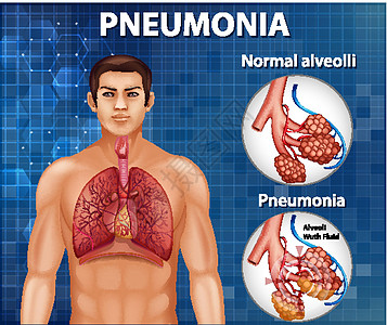 健康肺泡与肺炎的比较教育微生物学气体气管器官疾病空气男性科学x光图片