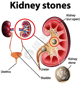 肾结石资料图插图绘画信息生物学图表膀胱生理意义教育艺术图片