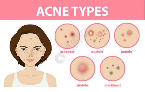 皮肤上的粉刺或粉刺类型卡通片真皮空白白头黑头疾病眼睛结节框架瘢痕图片