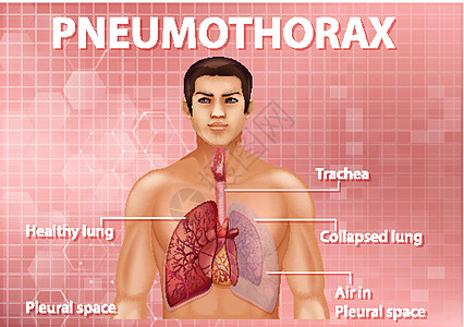 气胸的资料图绘画空气微生物学x光图表生物学气胸插图气管解剖学图片