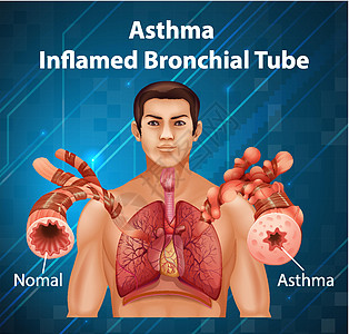 人体解剖学哮喘发炎的支气管管图病理管子哮喘生物绘画插图药品解剖学生物学信息图片