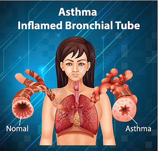 人体解剖学哮喘发炎的支气管管图生理绘画插图病理科学教育解剖学生物学信息生活图片