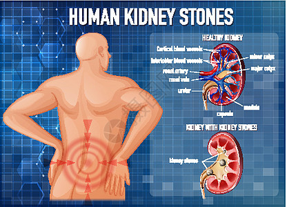 健康肾与结石肾对比生理教育身体病理图表卡通片男性药品意义男人图片