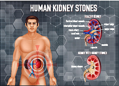 健康肾与结石肾对比微生物学身体绘画生物学生理学习图表胶囊病理解剖学图片
