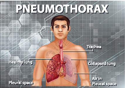人体解剖学气胸图图片