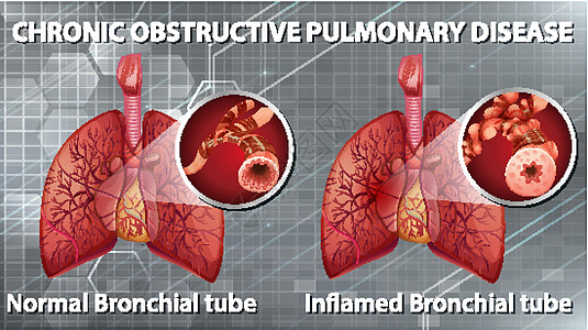 慢性阻塞性肺病微生物学疾病支气管生理学习插图教育信息药品图表图片