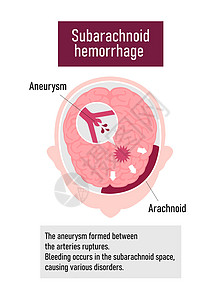 人类脑中中风矢量说明类型出血静脉插图船只情况动脉警告脑血管攻击信息脑梗塞图片