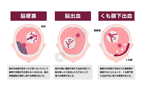 人类脑中中风病媒说明类型高血压脑梗塞中风船只警告大脑攻击图表静脉疾病图片