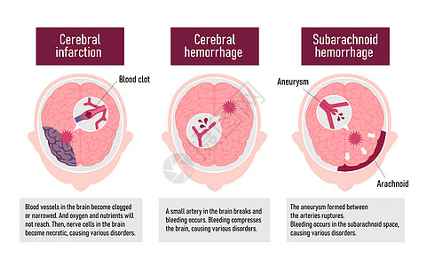 人类脑中中风病媒说明类型动脉药品心血管静脉脑梗塞压力脑血管科学船只情况图片
