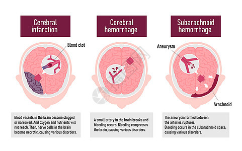 人类脑中中风病媒说明类型动脉药品心血管静脉脑梗塞压力脑血管科学船只情况图片