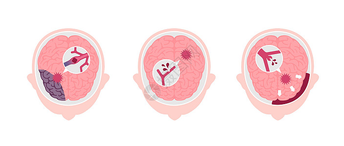 人类脑中中风病媒说明类型中风大脑情况压力科学脑梗塞高血压船只静脉警告图片