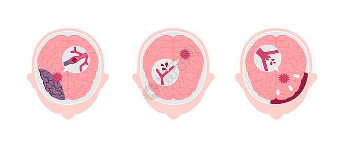 人类脑中中风病媒说明类型中风大脑情况压力科学脑梗塞高血压船只静脉警告图片