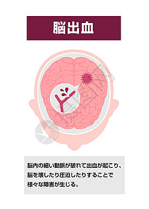 人类脑中中风病媒说明类型 脑出血中风脑梗塞信息压力动脉粥样硬化血管疼痛船只图表疾病图片