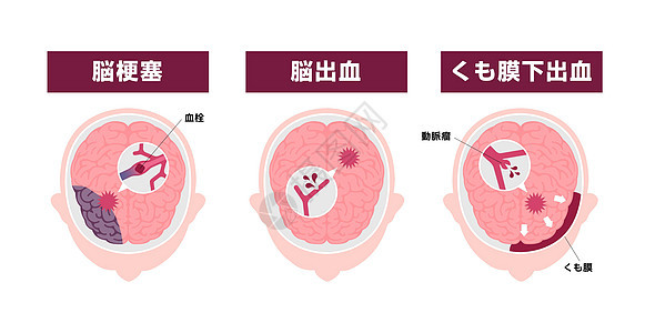 人类脑中中风病媒说明类型血管动脉压力心血管科学疼痛疾病解剖学脑血管高血压图片