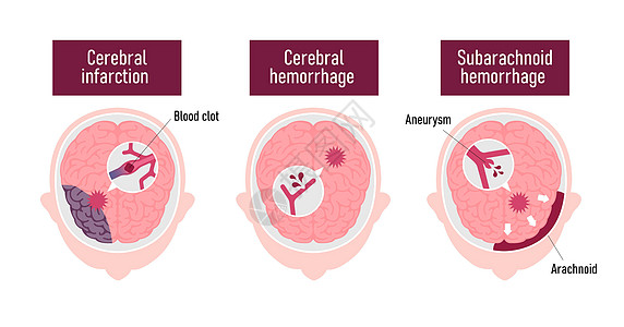 人类脑中中风病媒说明类型大脑信息静脉情况动脉粥样硬化动脉压力心血管船只脑血管图片