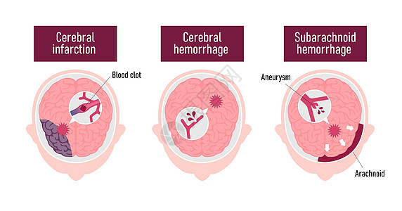 人类脑中中风病媒说明类型大脑信息静脉情况动脉粥样硬化动脉压力心血管船只脑血管图片