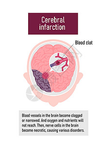 人脑中风的类型矢量图脑梗塞脑梗塞药品血管科学情况动脉粥样硬化大脑中风疾病压力图片