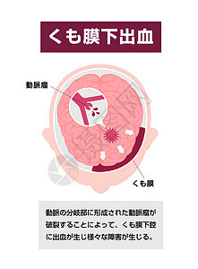 人类脑中中风矢量说明类型出血情况插图静脉压力脑血管疾病攻击药品动脉血管图片