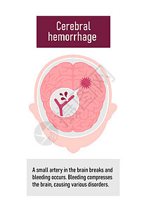 人类脑中中风病媒说明类型 脑出血图表药品动脉粥样硬化疾病血管解剖学大脑压力警告船只图片
