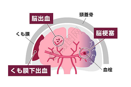 人类脑中中风病媒说明类型攻击血管动脉脑血管信息情况脑梗塞压力大脑图表图片