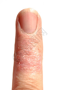 皮肤过敏性皮质拉什埃切马指伤口过敏疾病表皮疼痛手指卫生状况皮肤科皮炎图片