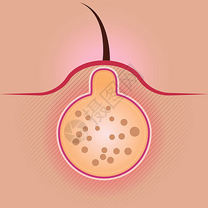它制作图案痤疮矢量图片