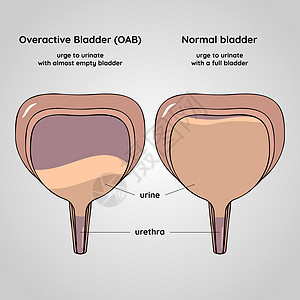过度活跃和正常的膀胱 泌尿系统疾病图片
