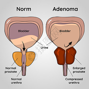 正常膀胱和 BPH 问题前列腺腺瘤医学载体它制作图案图片