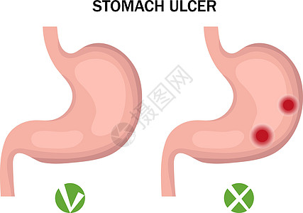 胃溃疡和健康腹部人口图表 医学概念 矢量插图图片