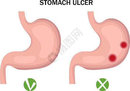 胃溃疡和健康腹部人口图表 医学概念 矢量插图图片