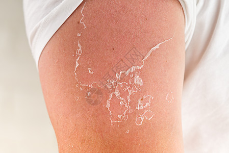 被阳光灼晒后皮肤剥皮 不使用防晒霜奶油裂缝疼痛皮炎皮肤科湿疹女性药品护理皱纹图片