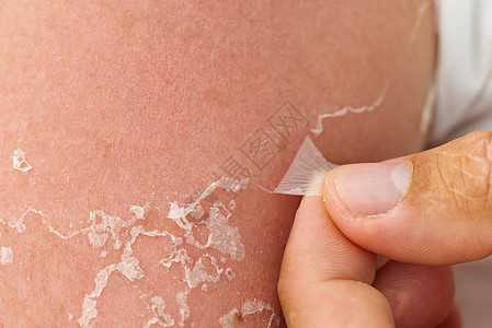 被阳光灼晒后皮肤剥皮 不使用防晒霜身体护理宏观治疗皮肤科表皮疾病奶油疼痛痛苦图片