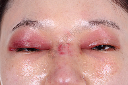 鼻子手术后 上额眼盖和鼻部肿胀图片