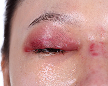 鼻子手术后上眼盖子肿胀的缝合圆圈身体状况伤口感染外科药品疾病眼皮伤疤图片