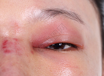 鼻子手术后上眼盖子肿胀的缝合伤疤圆圈工作状况药品疾病眼皮女孩睫毛感染图片