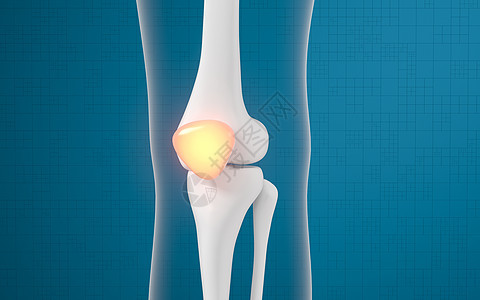 腿骨和膝盖损伤 3D感应骨科治疗蓝色手术外科药品软骨胫骨疼痛疾病图片