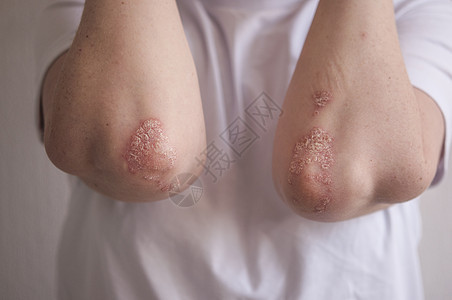 身穿白色T恤的年轻女子手肘皮肤上的丝虫病女孩成人皮炎手臂皮肤科疾病卫生症状病人保健图片