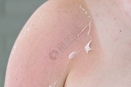 皮肤护理和紫外线保护概念 在男性身体上晒伤皮肤臭氧烧伤日光浴太阳损害肩膀晒黑痛苦水疱男人背景图片