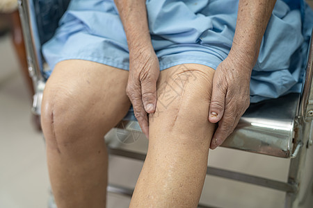 亚洲老年或老年老太太妇女病人在护理医院病房的床上展示她的疤痕手术全膝关节置换缝合伤口手术关节成形术 健康强大的医疗理念金属情况愈图片