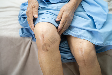亚洲老年或老年老太太妇女病人在护理医院病房的床上展示她的疤痕手术全膝关节置换缝合伤口手术关节成形术 健康强大的医疗理念瘢痕纤维外图片