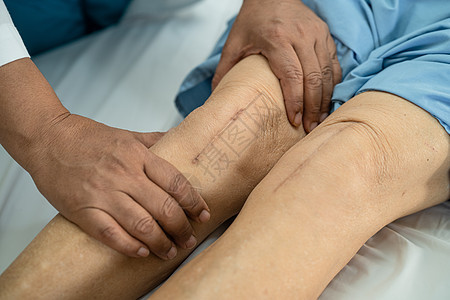亚洲老年或老年老太太妇女病人在护理医院病房的床上展示她的疤痕手术全膝关节置换缝合伤口手术关节成形术 健康强大的医疗理念金属皮肤主图片